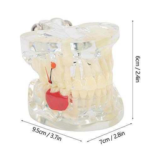 Diş Modeli, Diş Diş Modeli Laboratuvar Bilimsel Araştırma Aletleri Hastane Öğretim Sağlam Gösteri Diş Modeli, Diş Patolojik